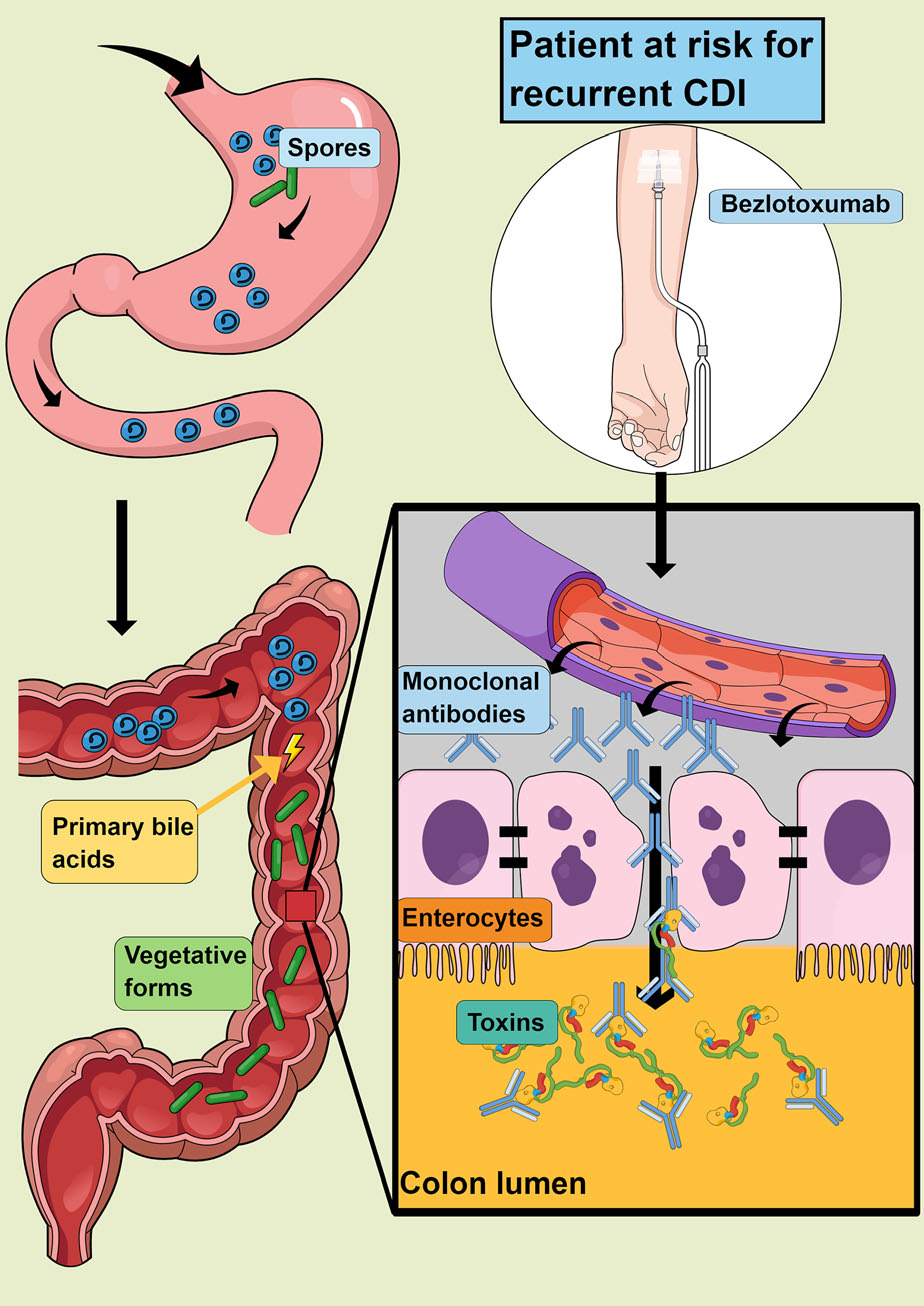 Clostridium difficile infection with toxins Toxin-A and-Toxin-B Clostridium difficile infection with toxins Toxin-A and-Toxin-B