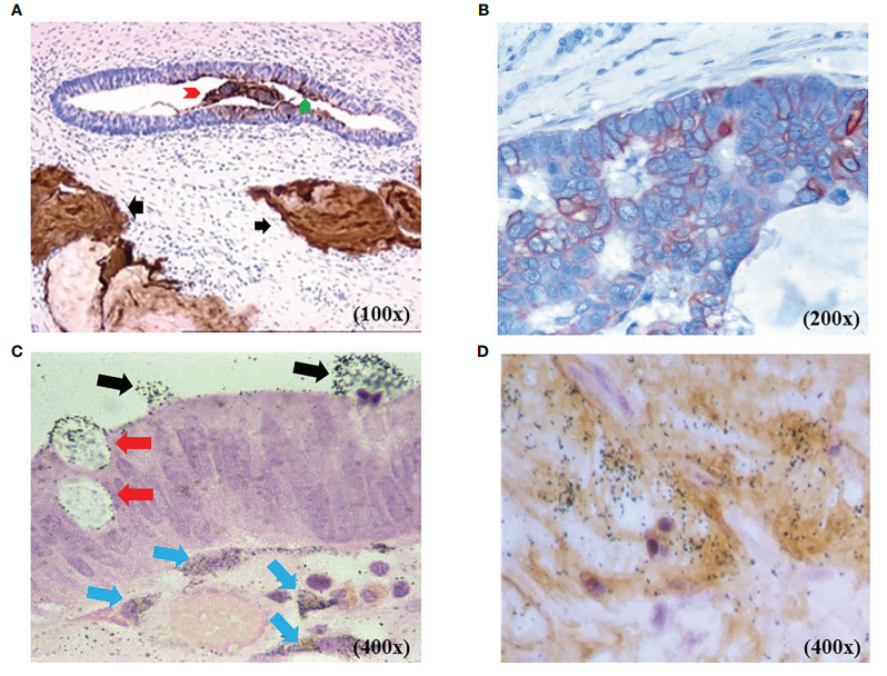 The tumor associated glycoprotein TAG-72 The tumor associated glycoprotein TAG-72