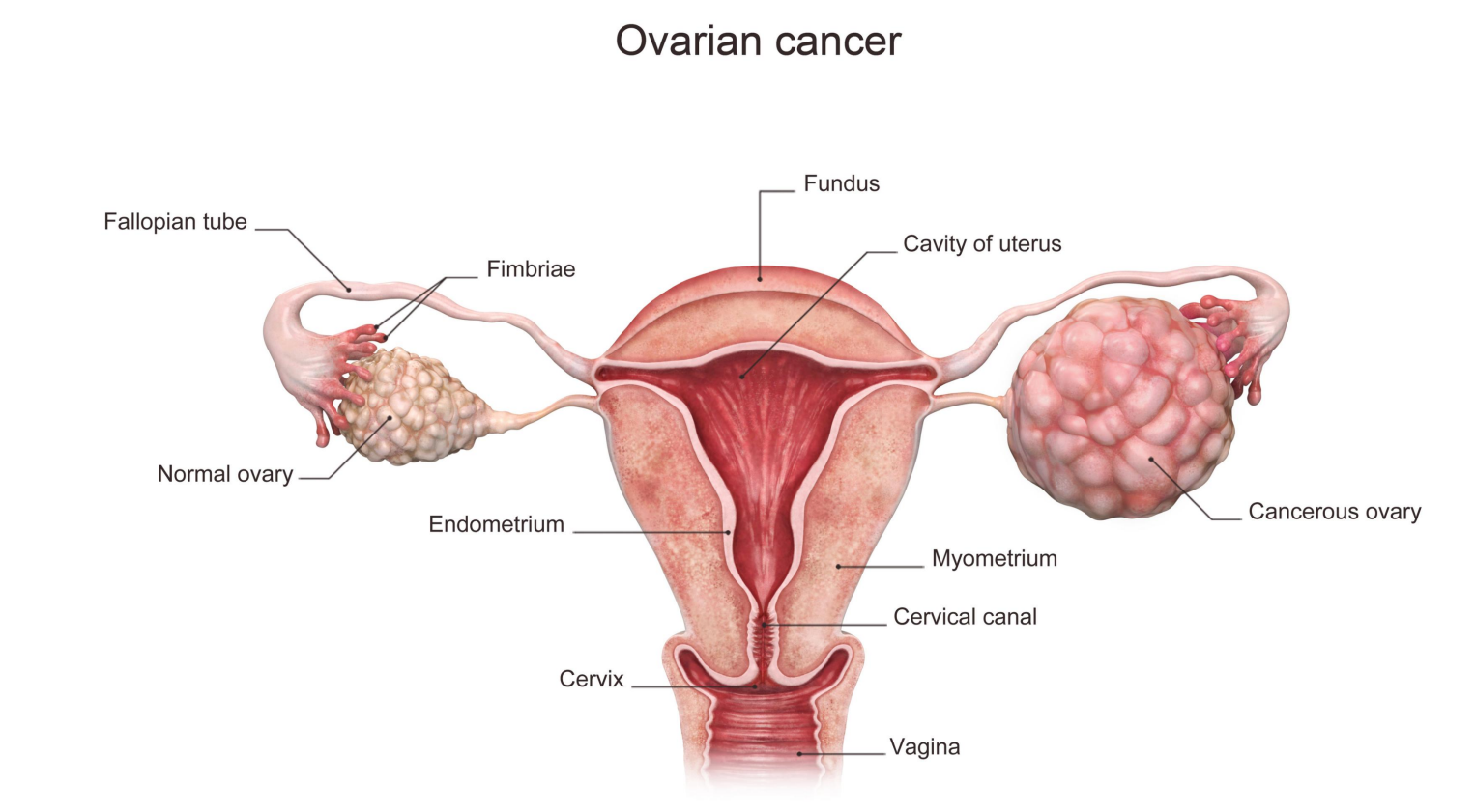 A new marker for ovarian cancer detection HE4