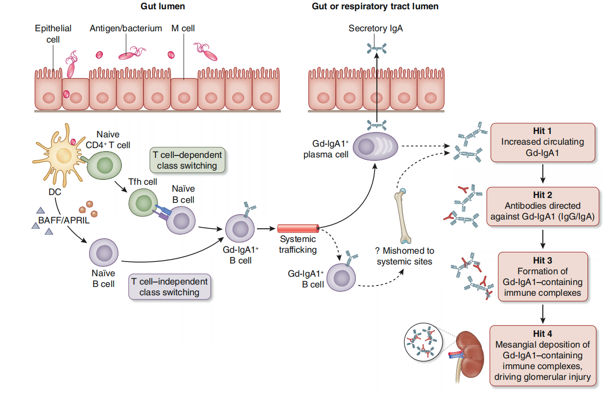 APRIL is a therapeutic target for IgA nephropathy