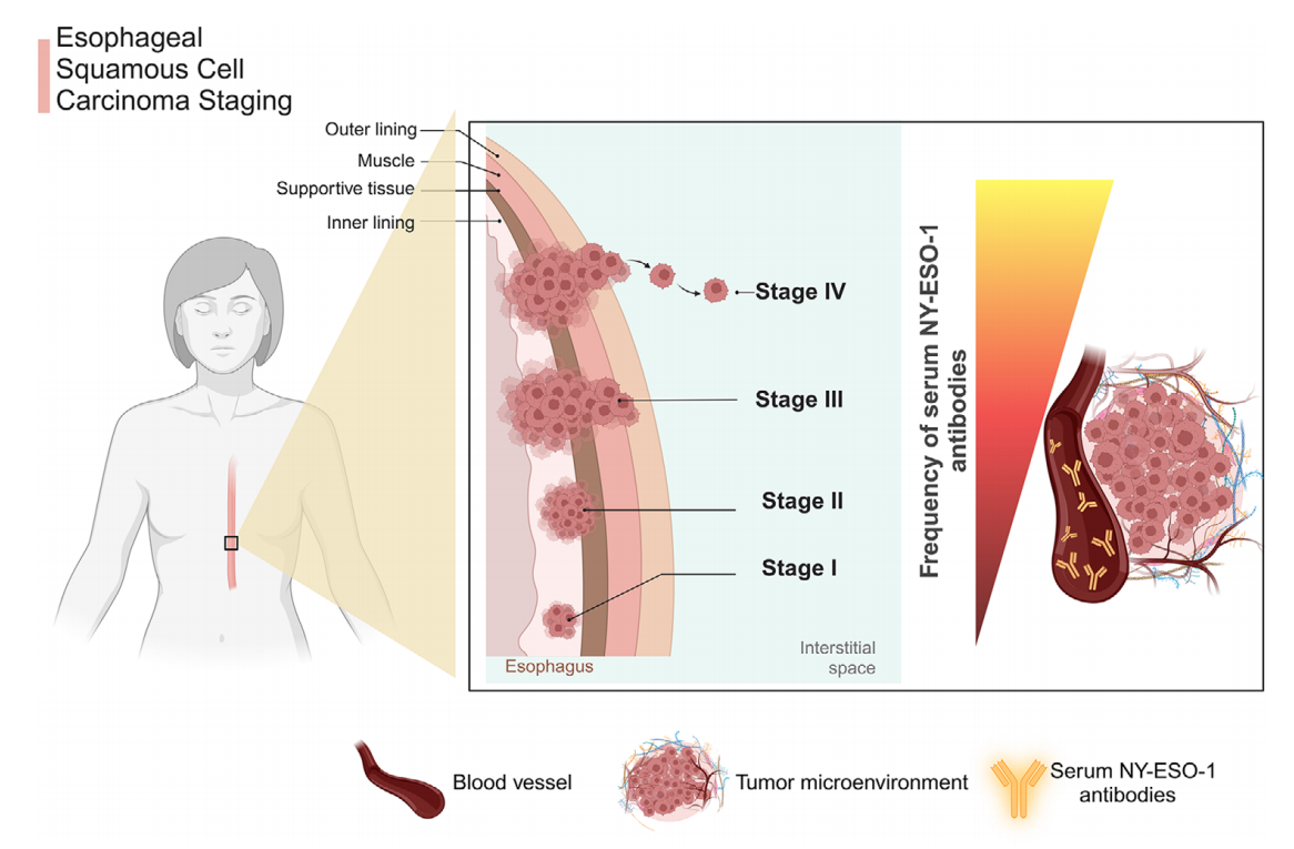 Autoimmune cancer testicular antigen NY-ESO-1