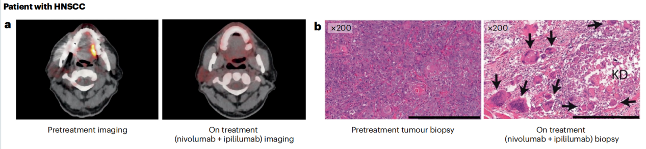 Cancer therapy with antibodies