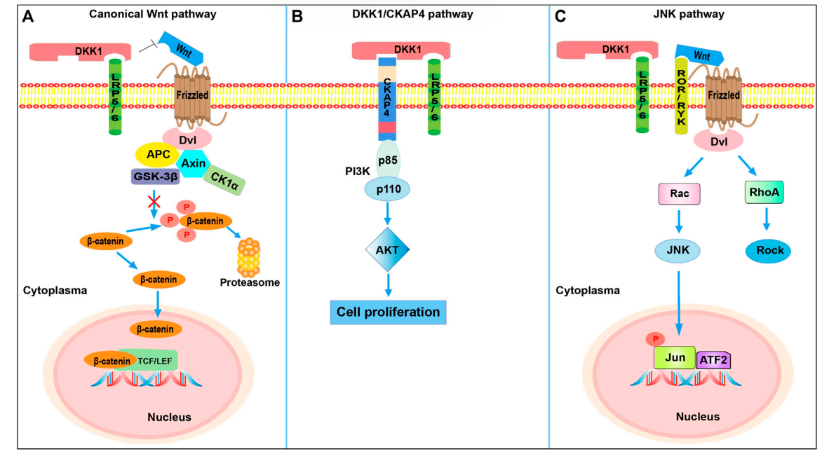 DKK1 is the core accomplicker of tumor immune escape