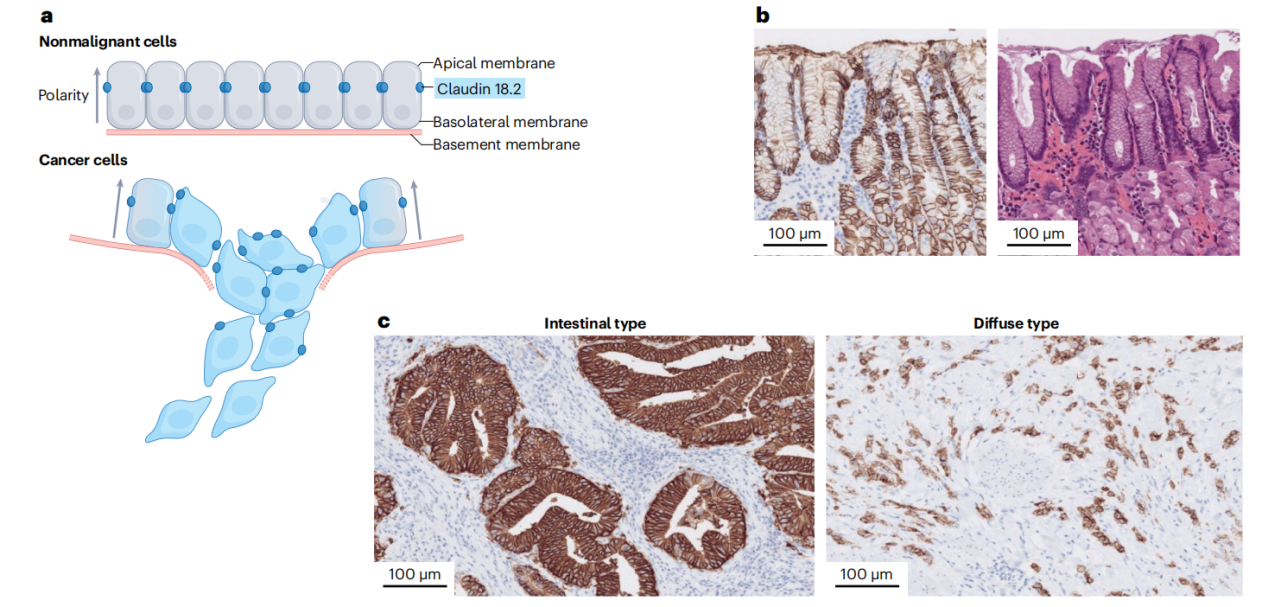 claudin18.2 is a new target for gastric and pancreatic cancer